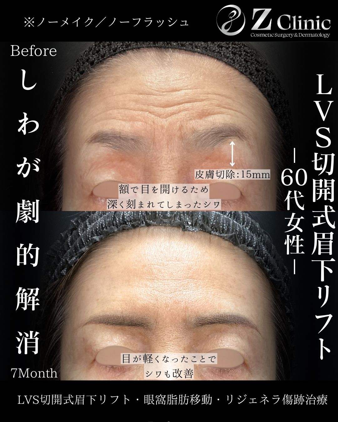 東京・銀座で眉下切開・眉下リフトの美容クリニックzclinicの画像2